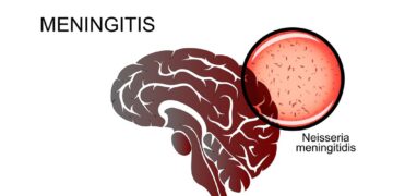 Confirmed Cases of Cerebrospinal Meningitis Spark Urgent Response in Gombe State: Commissioner of Health Takes Swift Action
