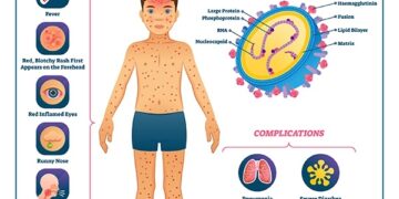 Health Ministry Confirms Measles Outbreak In Cross River Schools