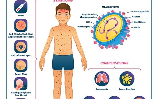 Health Ministry Confirms Measles Outbreak In Cross River Schools