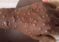 Mpox Alert in Nigeria: What You Can Do and Government Interventions