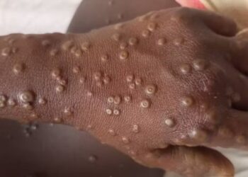 Mpox Alert in Nigeria: What You Can Do and Government Interventions