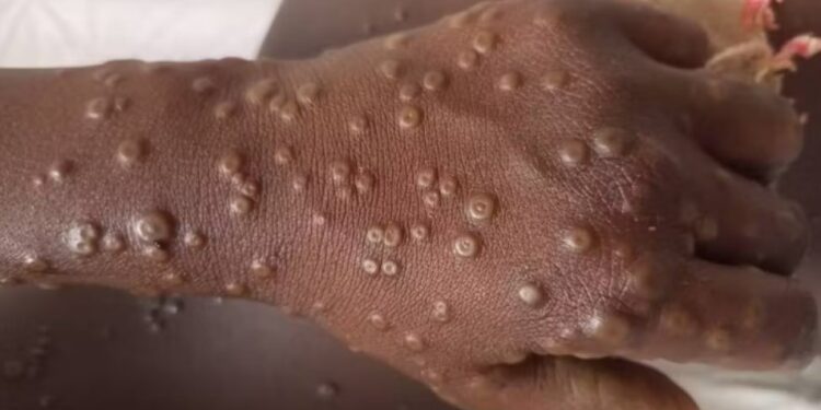 Mpox Alert in Nigeria: What You Can Do and Government Interventions
