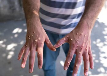 Nigeria on High Alert as Mpox Cases Rise Across Africa