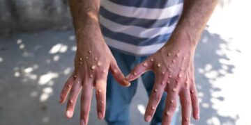 Nigeria on High Alert as Mpox Cases Rise Across Africa