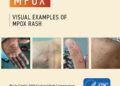 48 mpox cases in 19 states, FCT