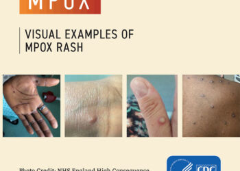 48 mpox cases in 19 states, FCT