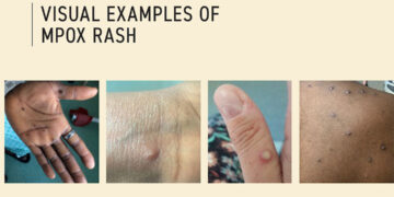 48 mpox cases in 19 states, FCT