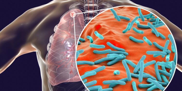 How Trump’s Foreign Aid Cuts Are Worsening Nigeria’s Tuberculosis Crisis